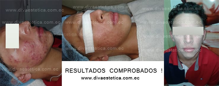 Limpieza Facial Profunda Diva Estetica Guayaquil