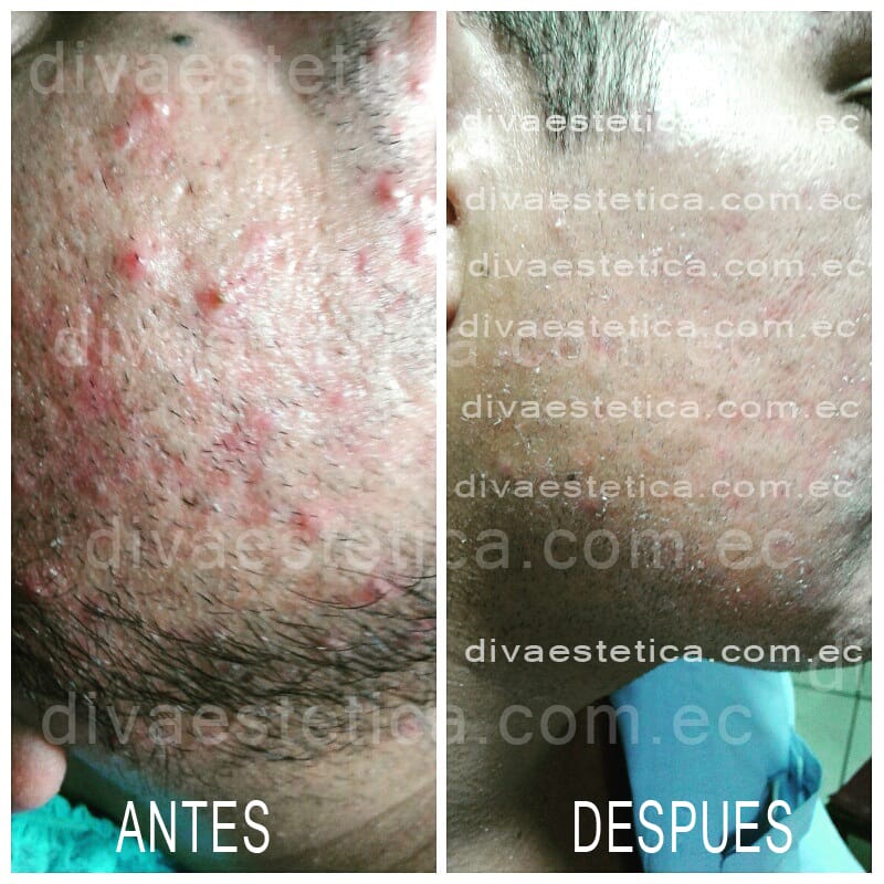 Limpieza Facial Profunda Diva Estetica Guayaquil