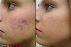 tratamiento para acne guayaquil