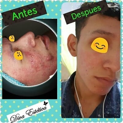 tratamiento acne guayaquil