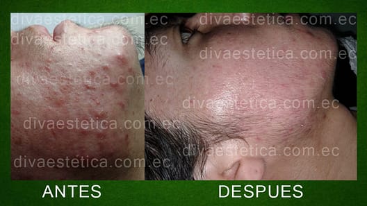 tratamiento acne guayaquil