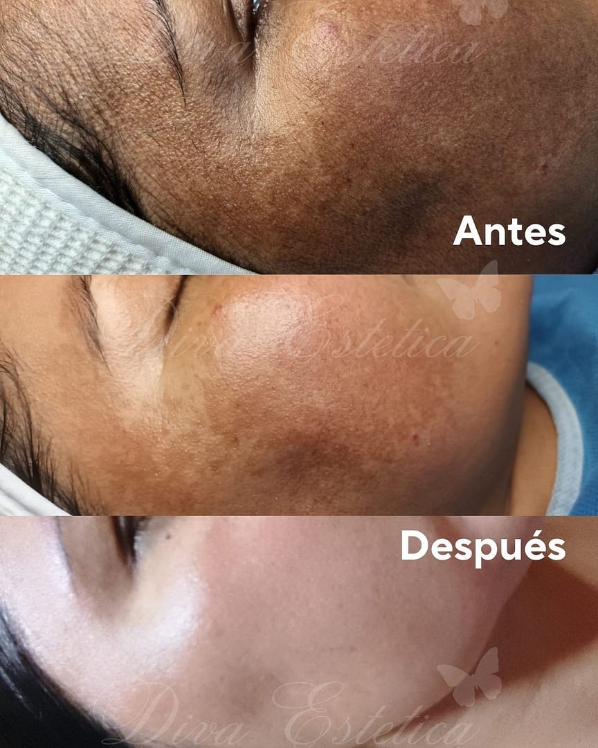 Despigmentación química