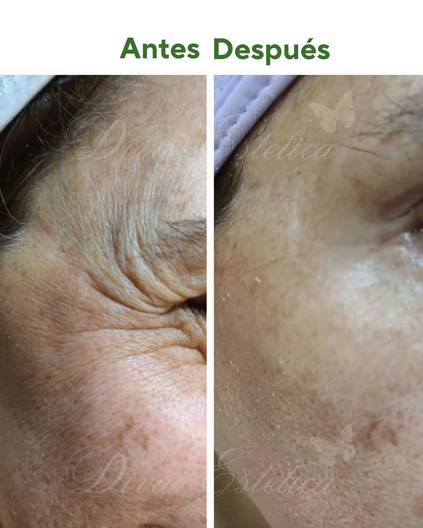 Plasma Rico en Plaquetas